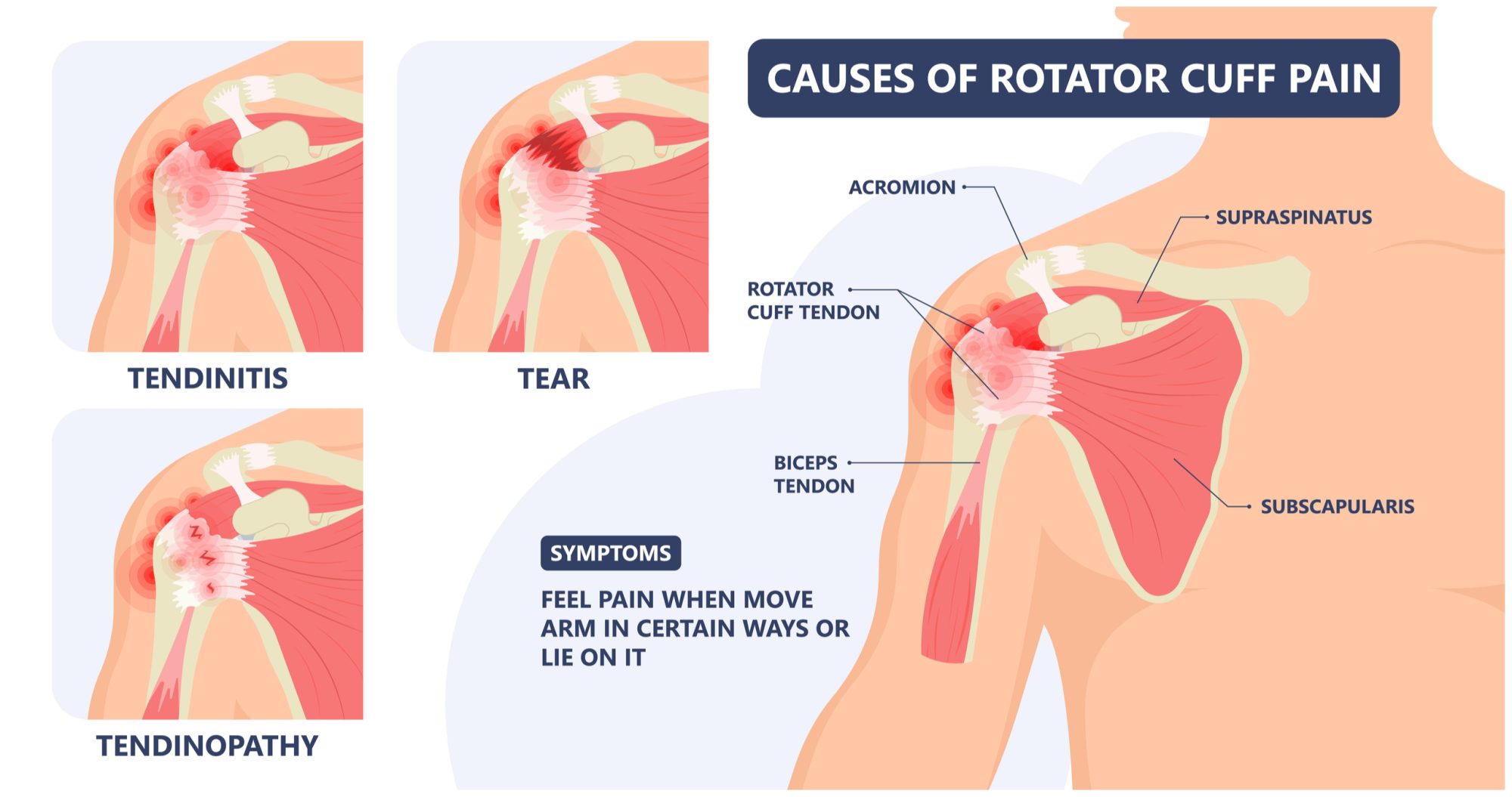 Rotator Cuff Therapy